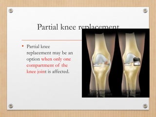 Partial knee replacement
• Partial knee
replacement may be an
option when only one
compartment of the
knee joint is affected.
 