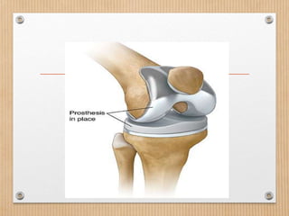 Total joint replacement
 