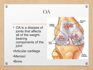 OA
• OA is a disease of
joints that affects
all of the weight-
bearing
components of the
joint:
•Articular cartilage
•Menisci
•Bone
 