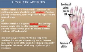 3. PSORIATIC ARTHRITIS
Psoriatic arthritis is a condition that combines the
swollen, sore joints of arthritis with psoriasis. Psoriasis
typically causes itchy, scaly red patches to appear on the
skin and scalp.
OR
Psoriatic arthritis is a type of arthritis that develops
in some people with the skin condition psoriasis. It
typically causes affected joints to become inflamed
(swollen), stiff and painful.
Like psoriasis, psoriatic arthritis is a long-term
condition that can get progressively worse. In severe
cases, there's a risk of the joints becoming permanently
damaged or deformed, which may require surgical
treatment.
 