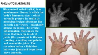 RHEUMATOID ARTHRITIS
Rheumatoid arthritis (RA) is an
autoimmune disease in which the
body’s immune system – which
normally protects its health by
attacking foreign substances like
bacteria and viruses – mistakenly
attacks the joints. This creates
inflammation that causes the
tissue that lines the inside of
joints (the synovium) to thicken,
resulting in swelling and pain in
and around the joints. The
synovium makes a fluid that
lubricates joints and helps them
move smoothly.
 