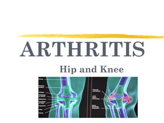 ARTHRITIS Hip and Knee 