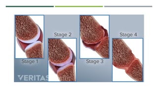 Arthritis and its types