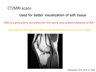 ARTHRITIS SLE AND OSTEOARTROSİS PPT .ppt