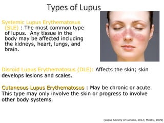 Sle Types ARTHRITIS SLE AND OSTEOARTROSİS PPT .ppt