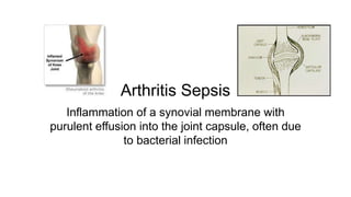 Arthritis Sepsis
Inflammation of a synovial membrane with
purulent effusion into the joint capsule, often due
to bacterial infection
 