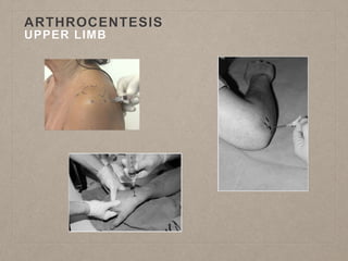 ARTHROCENTESIS
UPPER LIMB
 