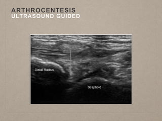 ARTHROCENTESIS
ULTRASOUND GUIDED
 