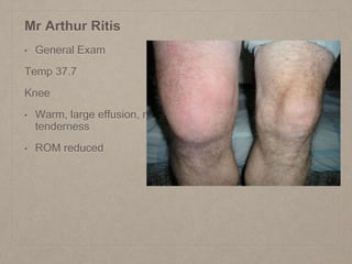 Mr Arthur Ritis
• General Exam
Temp 37.7
Knee
• Warm, large effusion, mild
tenderness
• ROM reduced
 