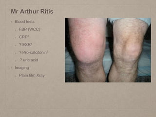Mr Arthur Ritis
• Blood tests
FBP (WCC)1
CRP2
? ESR1
? Pro-calcitonin3
? uric acid
• Imaging
Plain film Xray
 