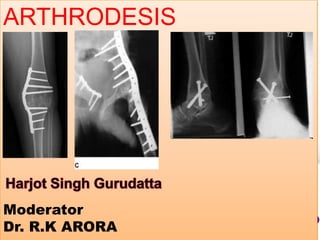 ARTHRODESIS

Moderator
Dr. R.K ARORA

 