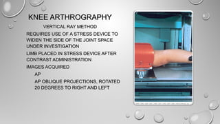 KNEE ARTHROGRAPHYKNEE ARTHROGRAPHY
VERTICAL RAY METHODVERTICAL RAY METHOD
REQUIRES USE OF A STRESS DEVICE TOREQUIRES USE OF A STRESS DEVICE TO
WIDEN THE SIDE OF THE JOINT SPACEWIDEN THE SIDE OF THE JOINT SPACE
UNDER INVESTIGATIONUNDER INVESTIGATION
LIMB PLACED IN STRESS DEVICE AFTERLIMB PLACED IN STRESS DEVICE AFTER
CONTRAST ADMINISTRATIONCONTRAST ADMINISTRATION
IMAGES ACQUIREDIMAGES ACQUIRED
APAP
AP OBLIQUE PROJECTIONS, ROTATEDAP OBLIQUE PROJECTIONS, ROTATED
20 DEGREES TO RIGHT AND LEFT20 DEGREES TO RIGHT AND LEFT
 