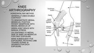 KNEEKNEE
ARTHROGRAPHYARTHROGRAPHY
HORIZONTAL RAY METHODHORIZONTAL RAY METHOD
GENERALLY USES DOUBLEGENERALLY USES DOUBLE
CONTRASTCONTRAST
TO DEMONSTRATE MEDIALTO DEMONSTRATE MEDIAL
MENISCUS, POSITIONMENISCUS, POSITION
PATIENT SEMIPRONE WITHPATIENT SEMIPRONE WITH
MEDIAL MENISCUS UPMEDIAL MENISCUS UP
WIDEN JOINT SPACE WITHWIDEN JOINT SPACE WITH
MANUAL STRESSMANUAL STRESS
CR CENTERED TO MEDIALCR CENTERED TO MEDIAL
SIDE OF KNEE ON MENISCUSSIDE OF KNEE ON MENISCUS
FOR FIRST EXPOSUREFOR FIRST EXPOSURE
MAKE SUBSEQUENT FIVEMAKE SUBSEQUENT FIVE
EXPOSURES, ROTATING LIMBEXPOSURES, ROTATING LIMB
TOWARD SUPINE 30TOWARD SUPINE 30
DEGREES FOR EACHDEGREES FOR EACH
EXPOSUREEXPOSURE
 