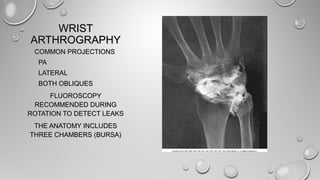WRISTWRIST
ARTHROGRAPHYARTHROGRAPHY
COMMON PROJECTIONSCOMMON PROJECTIONS
PAPA
LATERALLATERAL
BOTH OBLIQUESBOTH OBLIQUES
FLUOROSCOPYFLUOROSCOPY
RECOMMENDED DURINGRECOMMENDED DURING
ROTATION TO DETECT LEAKSROTATION TO DETECT LEAKS
THE ANATOMY INCLUDESTHE ANATOMY INCLUDES
THREE CHAMBERS (BURSA)THREE CHAMBERS (BURSA)
 