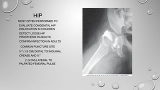 HIPHIP
MOST OFTEN PERFORMED TOMOST OFTEN PERFORMED TO
EVALUATE CONGENITAL HIPEVALUATE CONGENITAL HIP
DISLOCATION IN CHILDRENDISLOCATION IN CHILDREN
DETECT LOOSE HIPDETECT LOOSE HIP
PROSTHESIS IN ADULTSPROSTHESIS IN ADULTS
CONFIRM INFECTION IN ADULTSCONFIRM INFECTION IN ADULTS
COMMON PUNCTURE SITECOMMON PUNCTURE SITE
¾¾′′′′ (1.9 CM) DISTAL TO INGUINAL(1.9 CM) DISTAL TO INGUINAL
CREASE AND ¾CREASE AND ¾′′′′
(1.9 CM) LATERAL TO(1.9 CM) LATERAL TO
PALPATED FEMORAL PULSEPALPATED FEMORAL PULSE
 