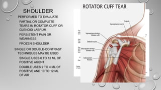SHOULDERSHOULDER
PERFORMED TO EVALUATEPERFORMED TO EVALUATE
PARTIAL OR COMPLETEPARTIAL OR COMPLETE
TEARS IN ROTATOR CUFF ORTEARS IN ROTATOR CUFF OR
GLENOID LABRUMGLENOID LABRUM
PERSISTENT PAIN ORPERSISTENT PAIN OR
WEAKNESSWEAKNESS
FROZEN SHOULDERFROZEN SHOULDER
SINGLE OR DOUBLE-CONTRASTSINGLE OR DOUBLE-CONTRAST
TECHNIQUES MAY BE USEDTECHNIQUES MAY BE USED
SINGLE USES 0 TO 12 ML OFSINGLE USES 0 TO 12 ML OF
POSITIVE AGENTPOSITIVE AGENT
DOUBLE USES 2 TO 4 ML OFDOUBLE USES 2 TO 4 ML OF
POSITIVE AND 10 TO 12 MLPOSITIVE AND 10 TO 12 ML
OF AIROF AIR
 