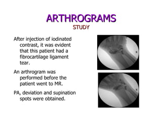 Arthrograms Presentation | PPT