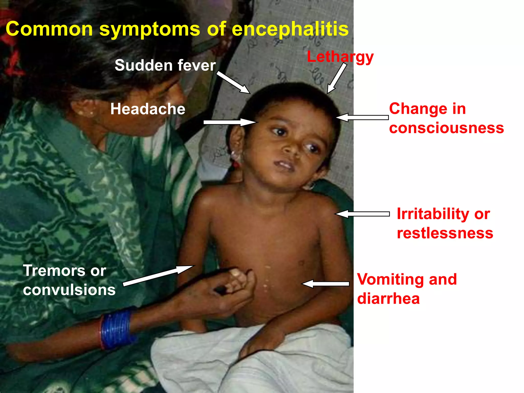 Common symptoms of encephalitis
                           Lethargy
           Sudden fever

           Headache                   Change in
                                      consciousness




                                      Irritability or
                                      restlessness

 Tremors or
                                  Vomiting and
 convulsions
                                  diarrhea
 