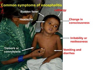 Common symptoms of encephalitis
                           Lethargy
           Sudden fever

           Headache                   Change in
                                      consciousness




                                      Irritability or
                                      restlessness

 Tremors or
                                  Vomiting and
 convulsions
                                  diarrhea
 