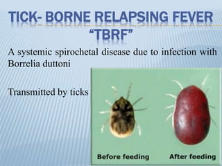 TICK- BORNE RELAPSING FEVER
“TBRF”
A systemic spirochetal disease due to infection with
Borrelia duttoni
Transmitted by ticks
 