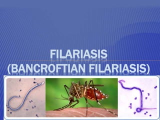 FILARIASIS
(BANCROFTIAN FILARIASIS)
 