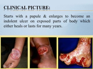 CLINICAL PICTURE:
Starts with a papule & enlarges to become an
indolent ulcer on exposed parts of body which
either heals or lasts for many years.
 
