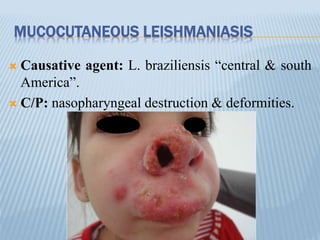 MUCOCUTANEOUS LEISHMANIASIS
 Causative agent: L. braziliensis “central & south
America”.
 C/P: nasopharyngeal destruction & deformities.
 