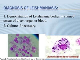 DIAGNOSIS OF LEISHMANIASIS:
1. Demonstration of Leishmania bodies in stained
smear of ulcer, organ or blood.
2. Culture if necessary.
 