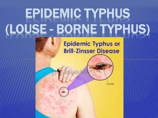 EPIDEMIC TYPHUS
(LOUSE - BORNE TYPHUS)
 
