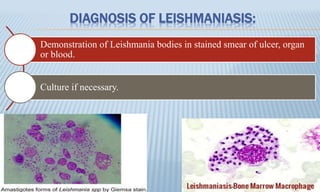 DIAGNOSIS OF LEISHMANIASIS:
Demonstration of Leishmania bodies in stained smear of ulcer, organ
or blood.
Culture if necessary.
 