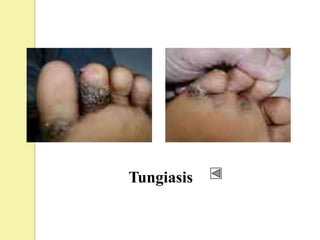 Tungiasis
 