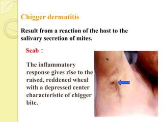 Chigger dermatitis
Result from a reaction of the host to the
salivary secretion of mites.
 Scab：

  The inflammatory
  response gives rise to the
  raised, reddened wheal
  with a depressed center
  characteristic of chigger
  bite.
 