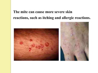 The mite can cause more severe skin
reactions, such as itching and allergic reactions.
 