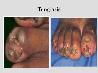 Tungiasis
 