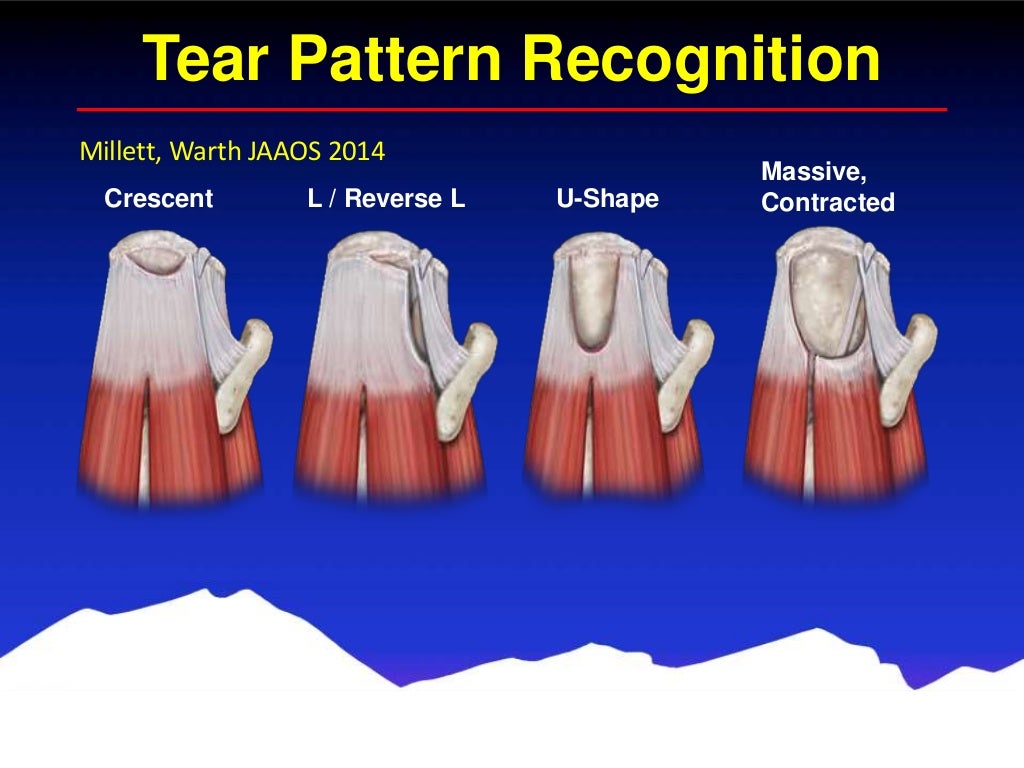 Arthroscopic Rotator Cuff Repair Colorado Shoulder Specialist Vai…