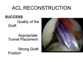 Arthroscopic ACL Reconstruction By Dr Shekhar Shrivastav | PDF