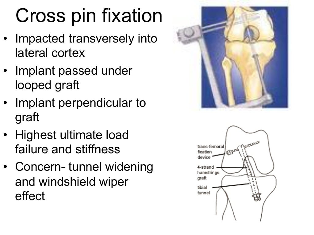 Arthroscopic ACL Reconstruction By Dr Shekhar Shrivastav