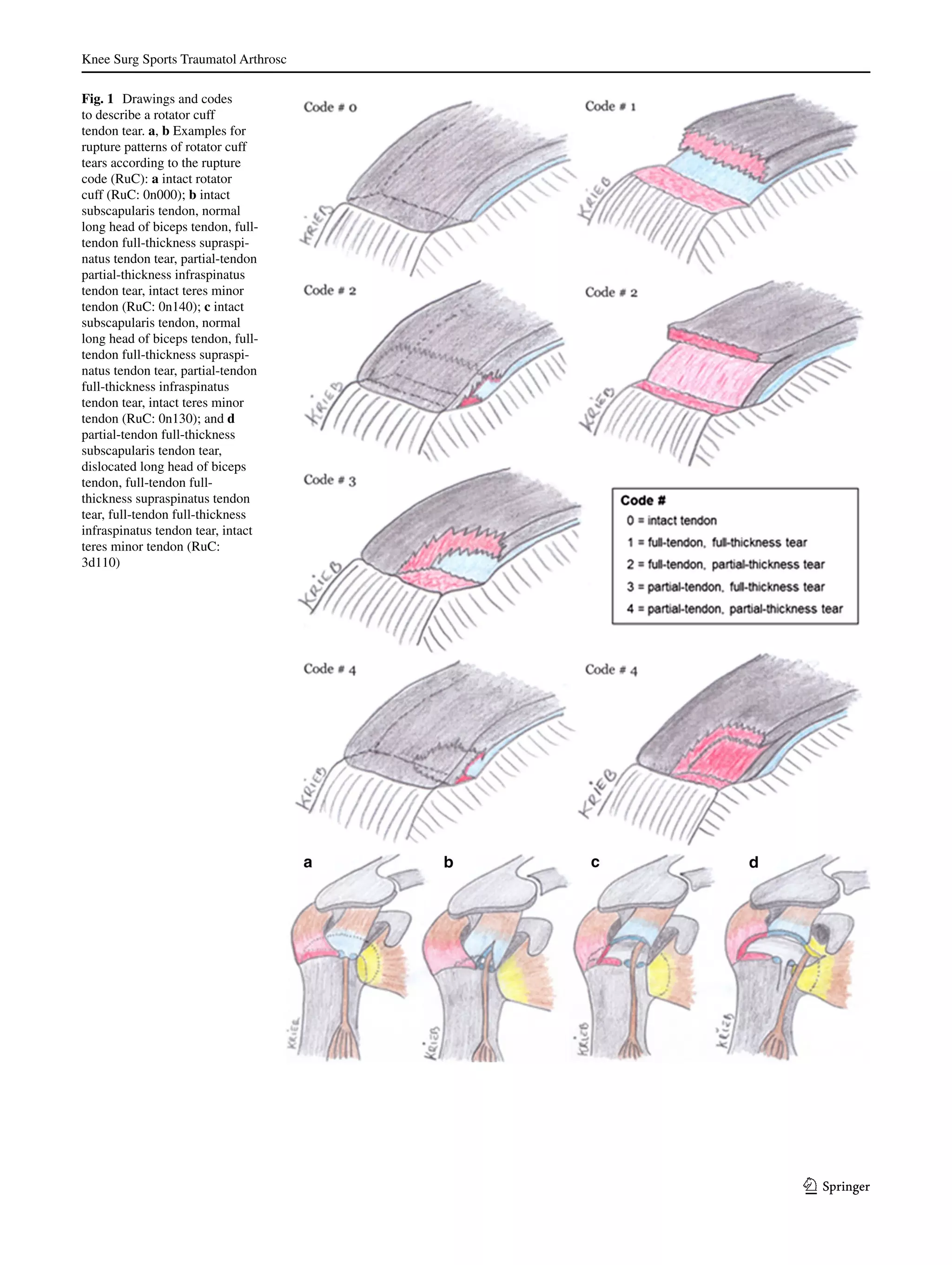 Arthroscopic management of massive rotator cuff tears an evaluation of ...