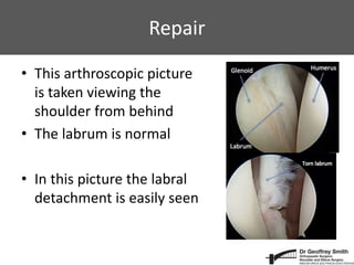 Repair
• This arthroscopic picture
is taken viewing the
shoulder from behind
• The labrum is normal
• In this picture the labral
detachment is easily seen
 