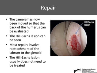 Repair
• The camera has now
been moved so that the
back of the humerus can
be evaluated
• The Hill-Sachs lesion can
be seen
• Most repairs involve
reattachment of the
labrum to the glenoid
• The Hill-Sachs lesion
usually does not need to
be treated
 