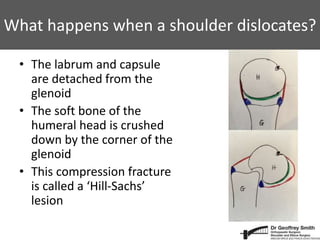 What happens when a shoulder dislocates?
• The labrum and capsule
are detached from the
glenoid
• The soft bone of the
humeral head is crushed
down by the corner of the
glenoid
• This compression fracture
is called a ‘Hill-Sachs’
lesion
 