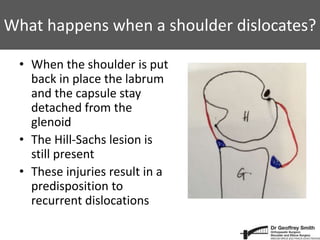What happens when a shoulder dislocates?
• When the shoulder is put
back in place the labrum
and the capsule stay
detached from the
glenoid
• The Hill-Sachs lesion is
still present
• These injuries result in a
predisposition to
recurrent dislocations
 