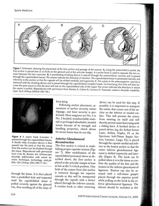 Arthroscopic Treatment of Anterior Glenohumeral Instability Indications and Techniques | Vail Sports Medicine