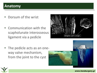 www.handsurgery.gr
Anatomy
• Dorsum of the wrist
• Communication with the
scapholunate interosseous
ligament via a pedicle...