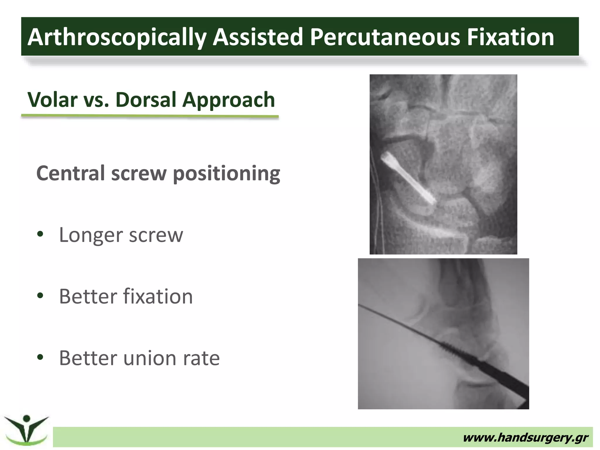 Arthroscopic treatment of scaphoid fractures & nonunions | PPTX