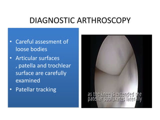 DIAGNOSTIC ARTHROSCOPY
• Careful assesment of
loose bodies
• Articular surfaces
, patella and trochlear
surface are carefully
examined
• Patellar tracking

 
