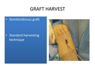 GRAFT HARVEST
• Semitendinous graft

• Standard harvesting
technique

 