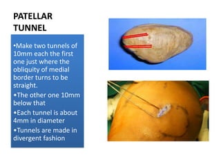 PATELLAR
TUNNEL
•Make two tunnels of
10mm each the first
one just where the
obliquity of medial
border turns to be
straight.
•The other one 10mm
below that
•Each tunnel is about
4mm in diameter
•Tunnels are made in
divergent fashion

 