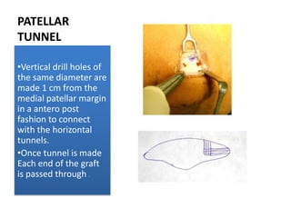 PATELLAR
TUNNEL
•Vertical drill holes of
the same diameter are
made 1 cm from the
medial patellar margin
in a antero post
fashion to connect
with the horizontal
tunnels.
•Once tunnel is made
Each end of the graft
is passed through .

 