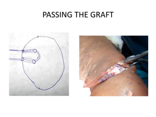 PASSING THE GRAFT

 